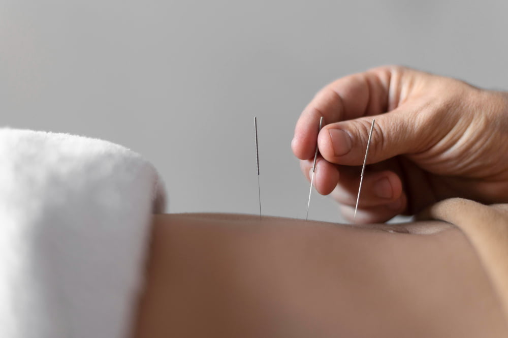 close up mao segurando agulha de acupuntura